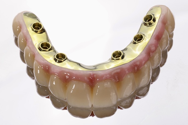 The Advantages Of Implant Supported Dentures Over Regular Ones